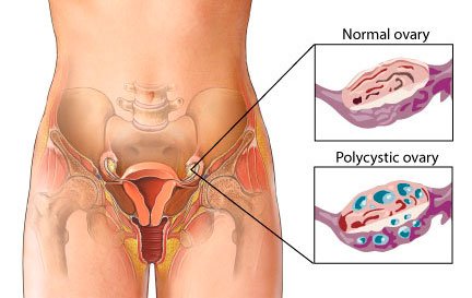 Think you have PCOS? Steps for reversing symptoms both holistically and naturally